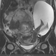 Image: NEJM, Pierre-Emmanuel Bouet, Centre Hospitalier Universitaire d’Angers, Angers, France